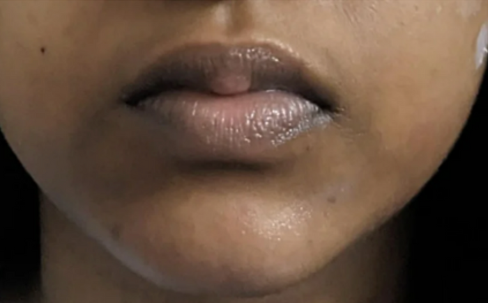 Case 4: Darkening Around the Mouth That Won't Fade — Perioral Pigmentation Explained