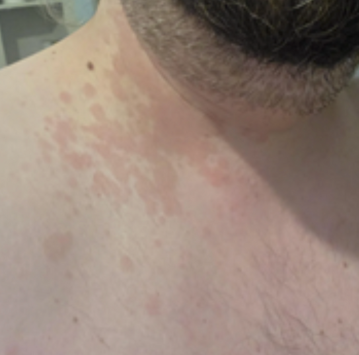 Case 39: Recurrent Reddish Patches on the Neck and Chest Every Summer — Pityriasis Versicolor (Erythematous Variant)