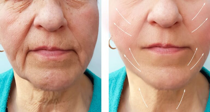 Anti-Ageing Treatment in Jaydev Vihar, Bhubaneswar: Botox, Fillers, HIFU & Skin Tightening