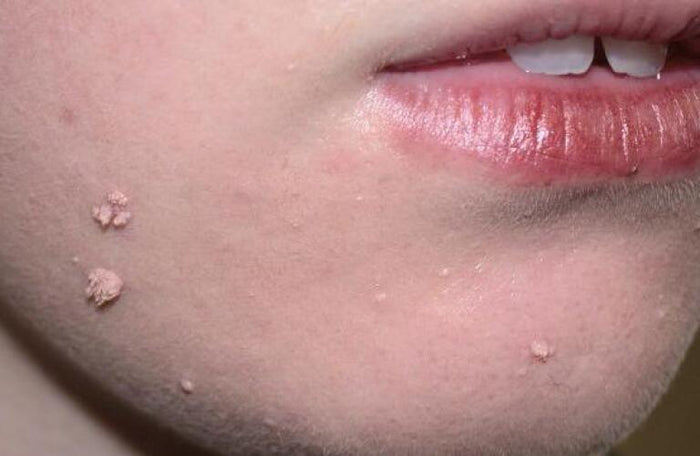 Case 29: Rough, Cauliflower-Like Growths on the Finger — Viral Warts (Verruca Vulgaris / Filiform Wart)