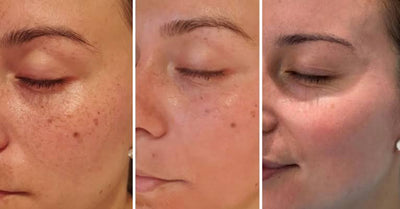 Cosmelan Peel in Dwarka, Delhi — A Doctor-Led Answer to Stubborn Pigmentation and Melasma