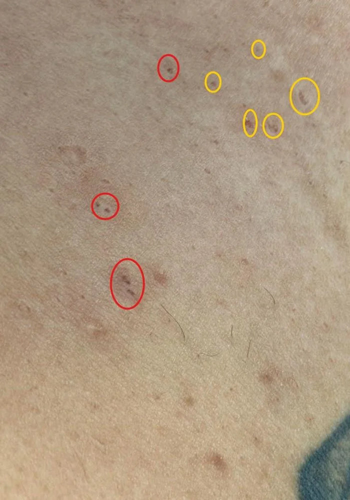 Case 36: 'Tiny Holes' Appearing in the Skin — Anetoderma and Focal Loss of Elastic Tissue