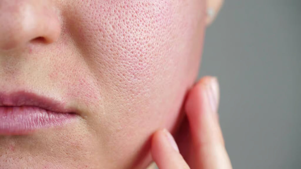 Open Pores Treatment Explained: Causes, What Actually Works, Best Procedures, Timelines, and Prevention