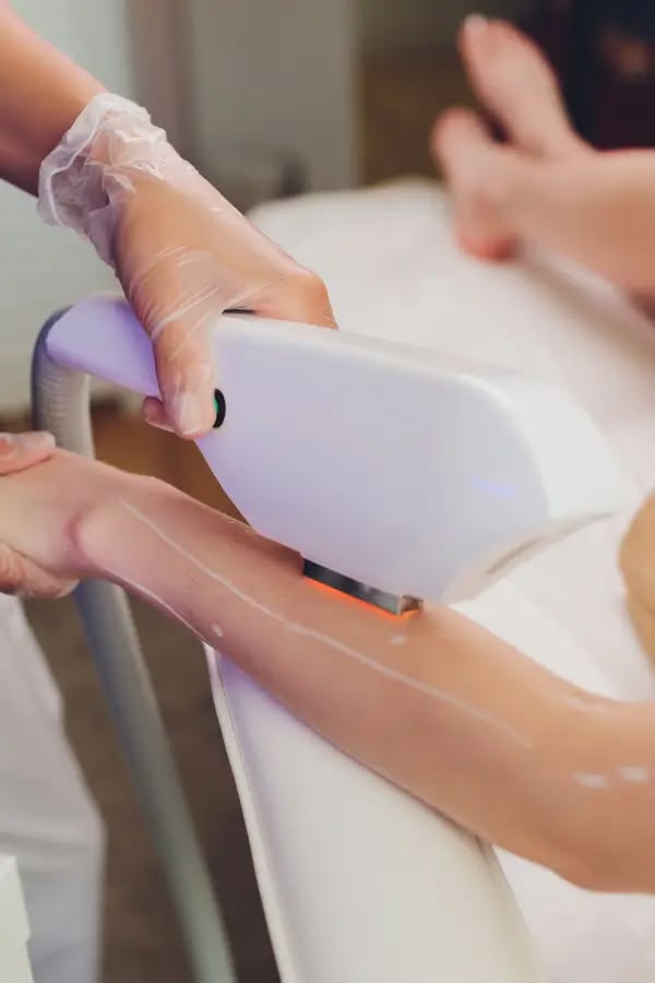 What is Laser Hair Removal — dermatologist explanation at Allodermis