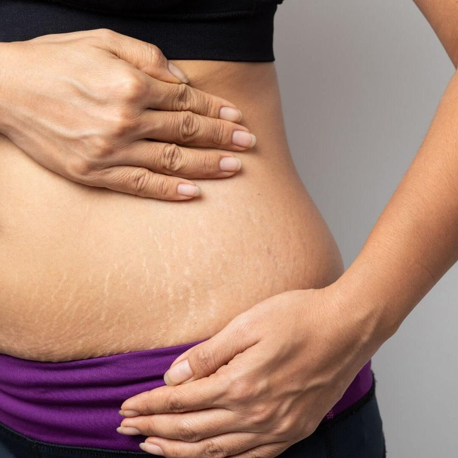 Stretch Marks treatment at Allodermis — AIIMS MD dermatologist clinic in India