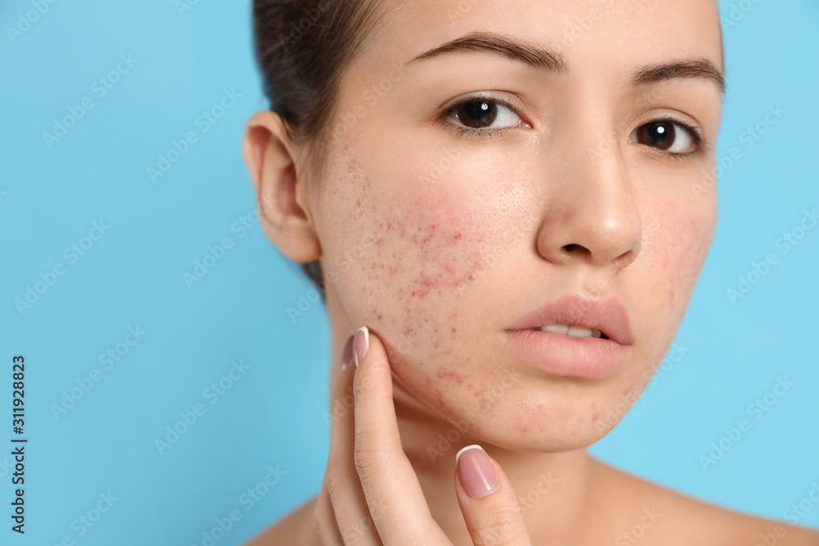 ACNE SCAR treatment at Allodermis — AIIMS MD dermatologist clinic in India