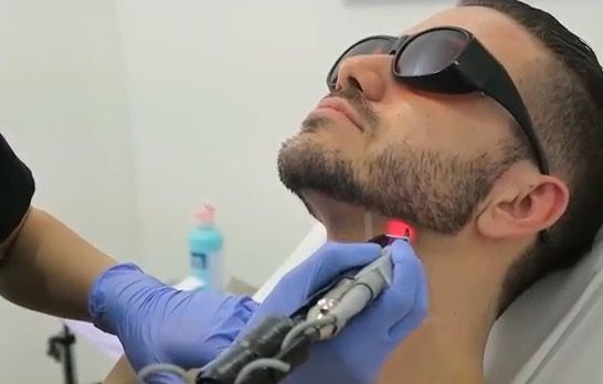 Laser Beard Shaping treatment at Allodermis — AIIMS MD dermatologist clinic in India