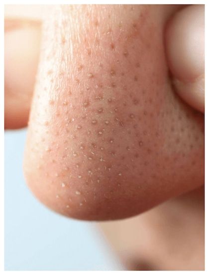 Open Pores treatment at Allodermis — AIIMS MD dermatologist clinic in India