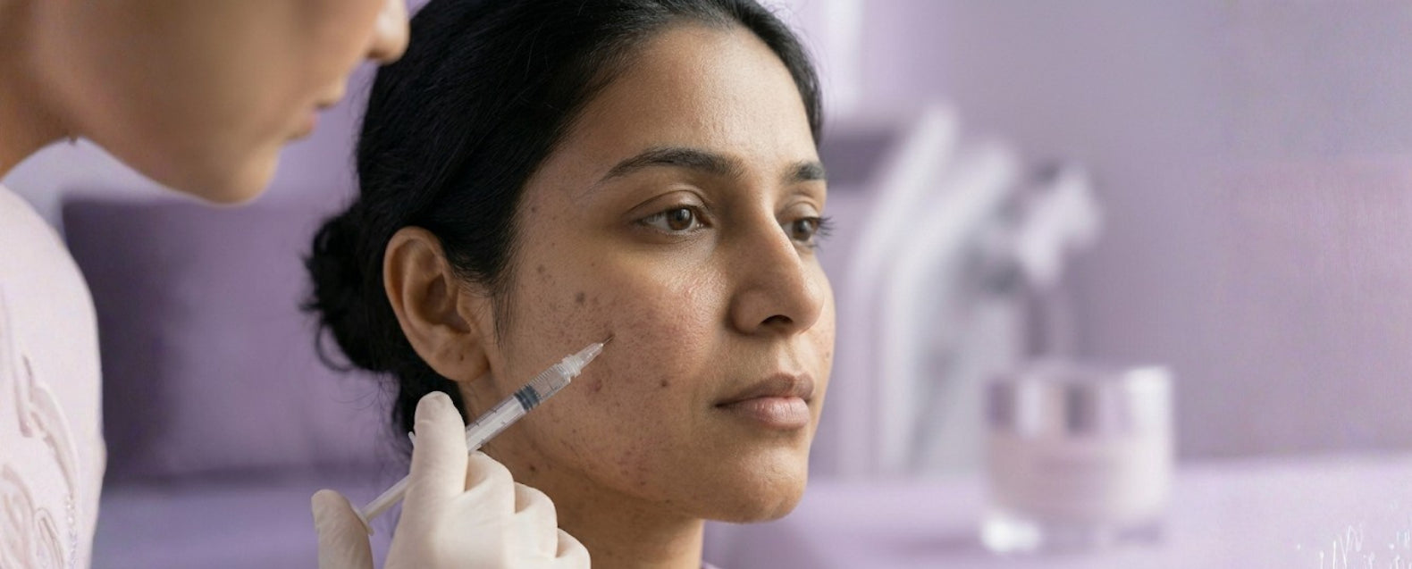 Acne causes