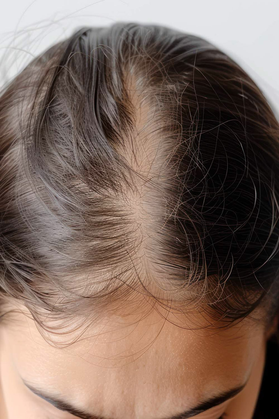 Allopecia(Hair Loss) treatment at Allodermis — AIIMS MD dermatologist clinic in India