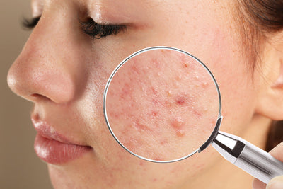 Acne Treatment in Chandrasekharpur, North Bhubaneswar: Causes, Types, Scars & Dermatologist Care