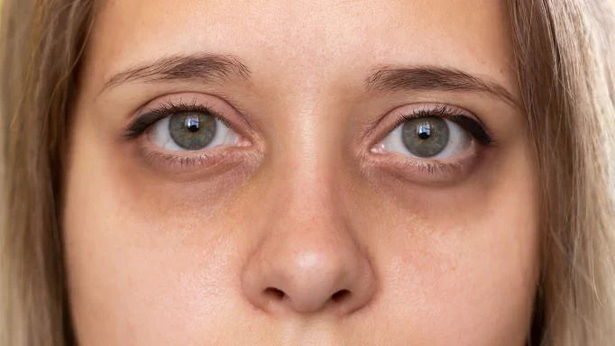 Dark Circles Under the Eyes: Causes, Treatment & Prevention