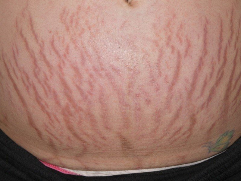 Case 37: Stretch Marks on the Inner Thighs After Pregnancy and Weight Change — Striae, Stages, and What Actually Helps