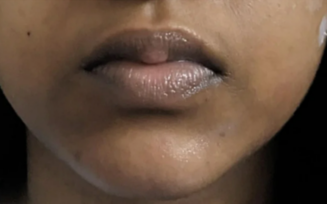 Case 4: Darkening Around the Mouth That Won't Fade — Perioral Pigmentation Explained
