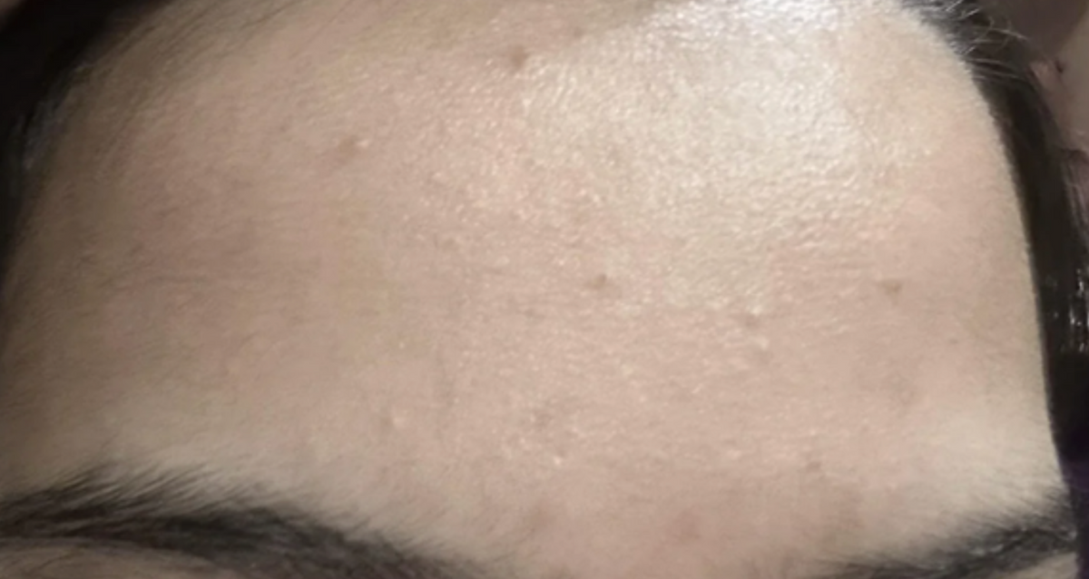 Case 1: Tiny White Bumps on the Forehead That Won't Go Away — Comedonal Acne Explained