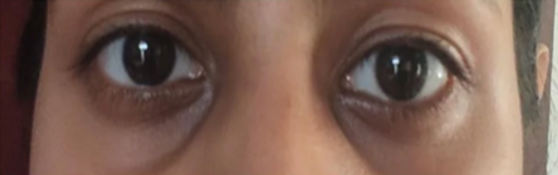 Case 2: Are All Dark Circles Pigmentation? The Hollow Under-Eye Most People Miss