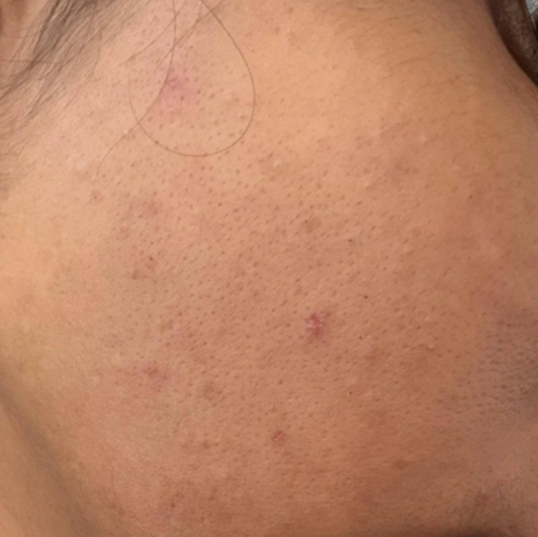 Case 3: Enlarged Pores or Acne Scars? Most People Treat the Wrong Thing