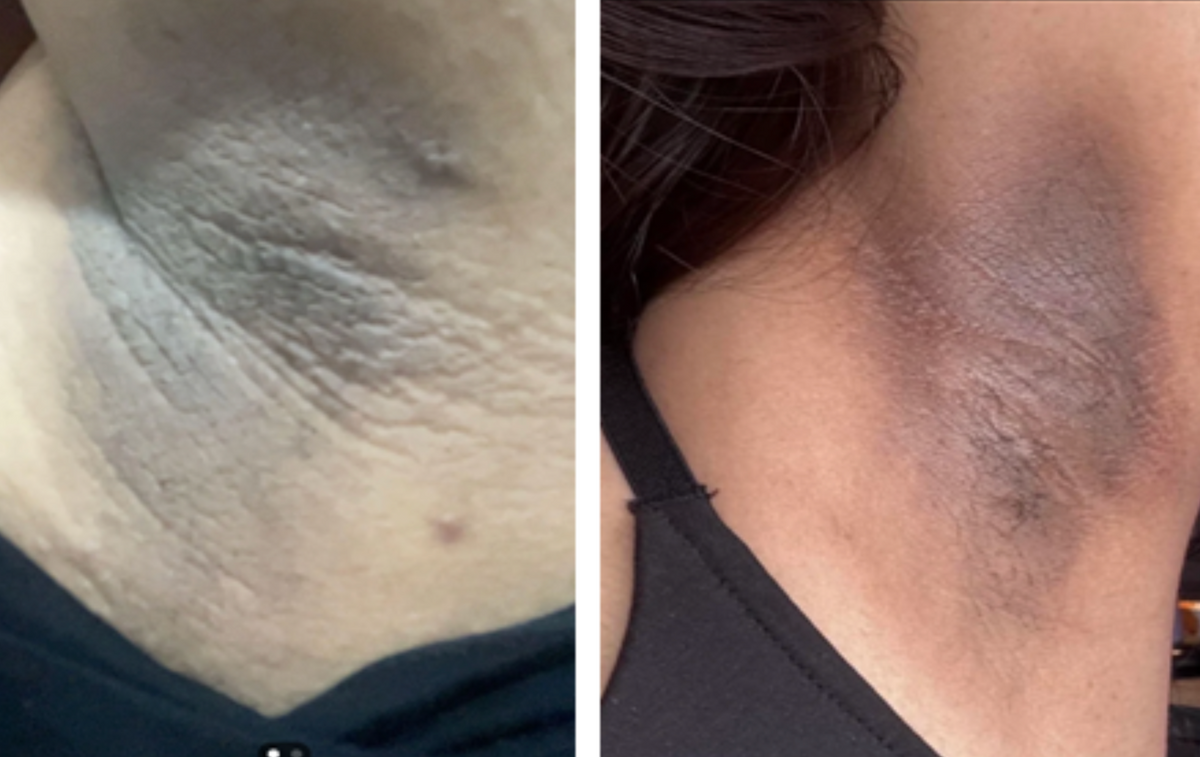 Case 7: Dark Underarms — Friction, Shaving Damage, or a Metabolic Warning Sign?