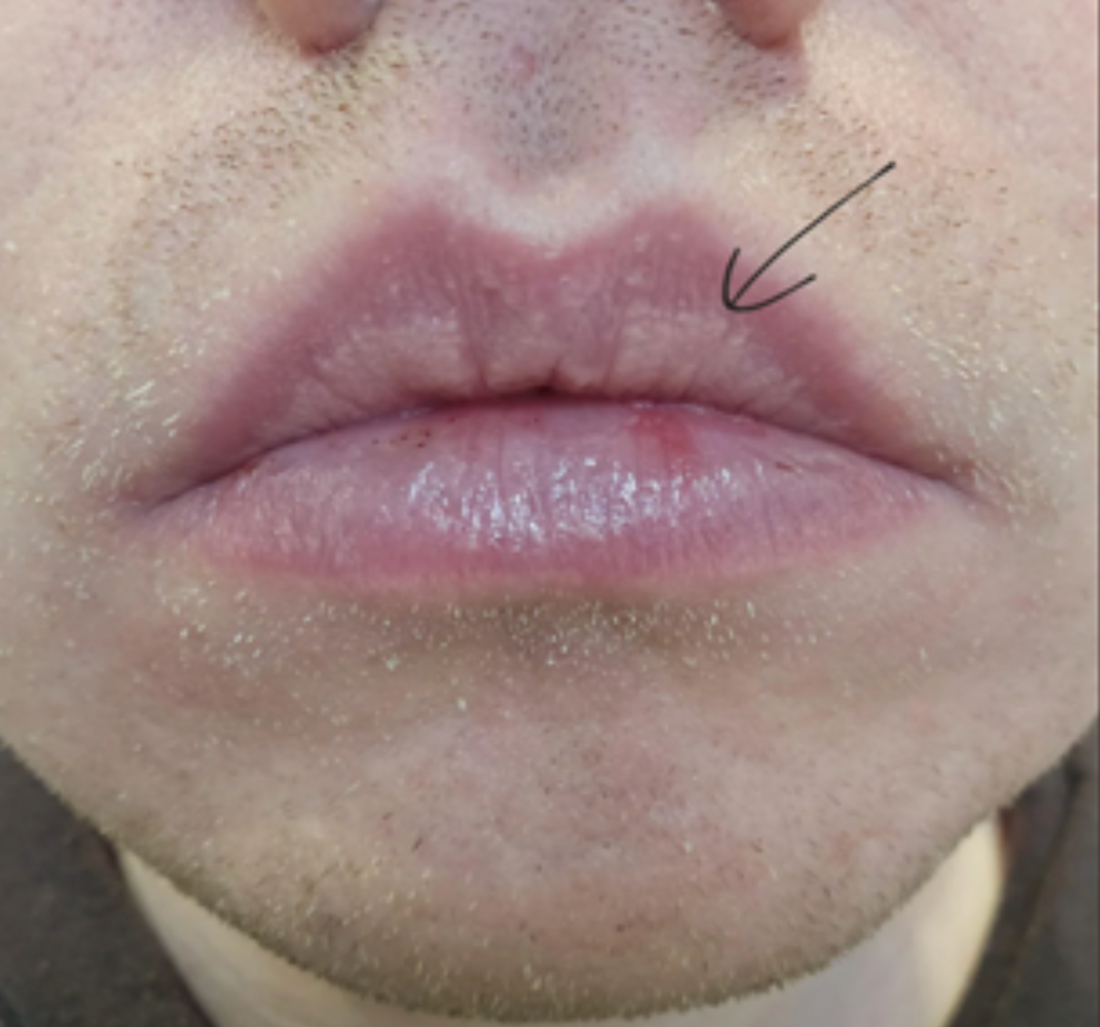Case 8: Tiny White-Yellow Bumps on the Lips — Fordyce Spots Are Normal, Not an STD