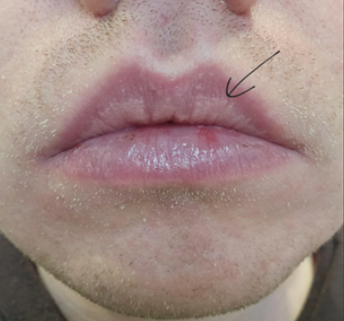 Case 8: Tiny White-Yellow Bumps on the Lips — Fordyce Spots Are Normal, Not an STD