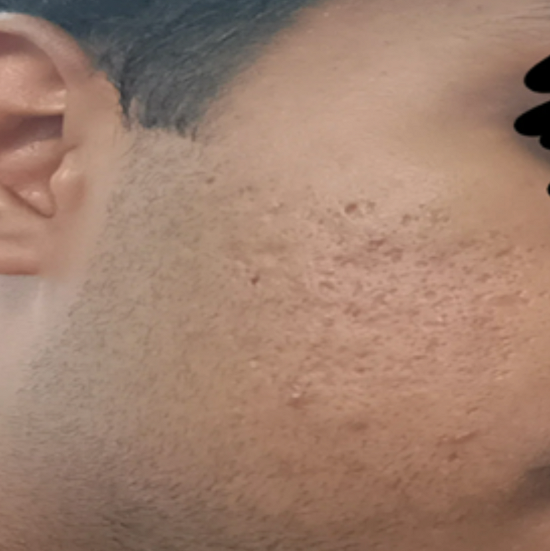 Case 9: Acne Scars CAN Be Prevented — and Treated. Here's the Full Picture