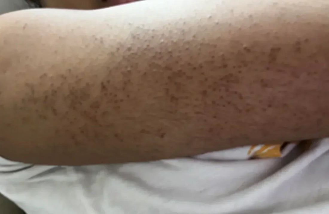 Case 15: 'Strawberry Skin' on Arms and Shoulders — Keratosis Pilaris with Pigmented Dots