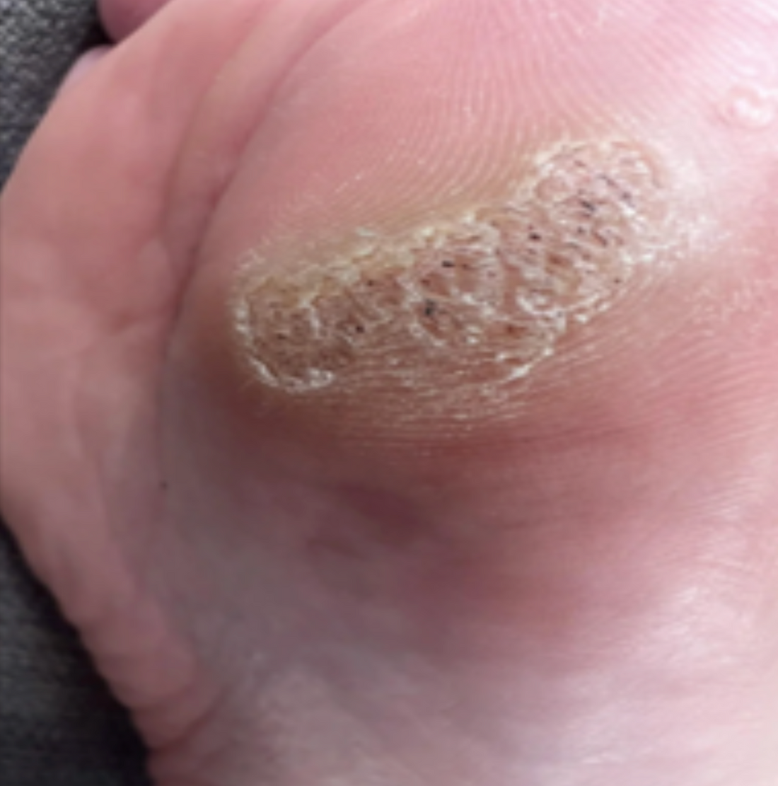 Case 11: Painful Thick Skin on the Sole — Is It a Corn or a Plantar Wart? Most People Treat the Wrong Thing