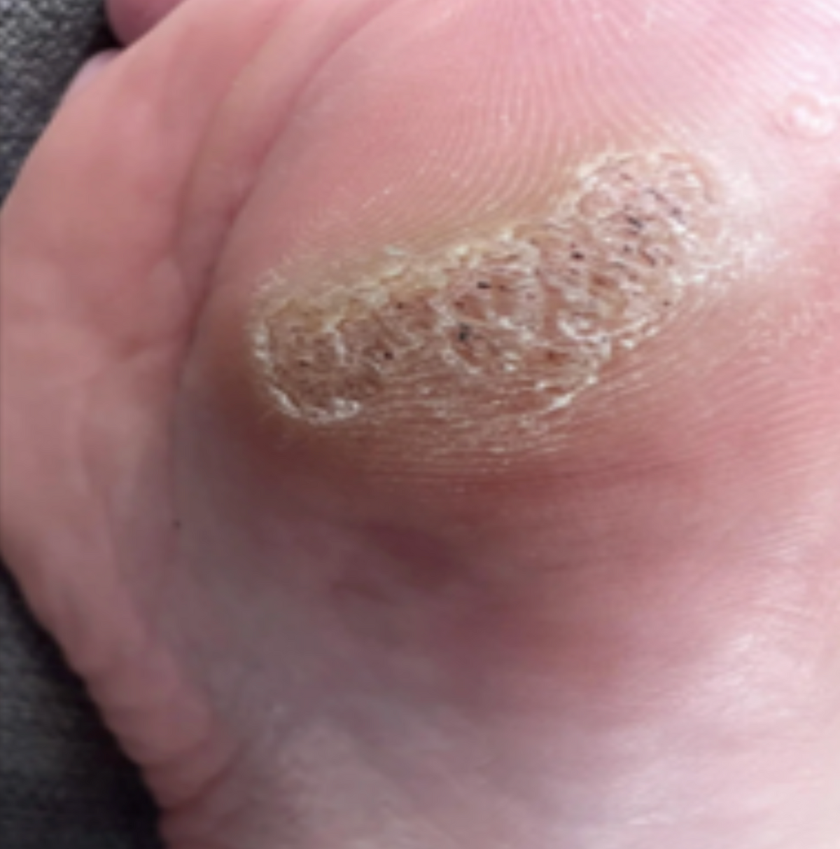 Case 11: Painful Thick Skin on the Sole — Is It a Corn or a Plantar Wart? Most People Treat the Wrong Thing