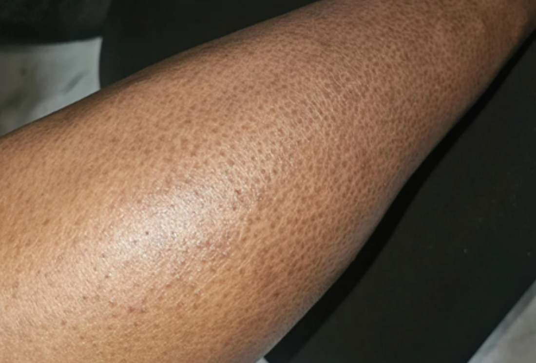 Case 5: Rough, Dull, 'Fish-Scale' Skin — Understanding Xerosis (Severe Dry Skin)