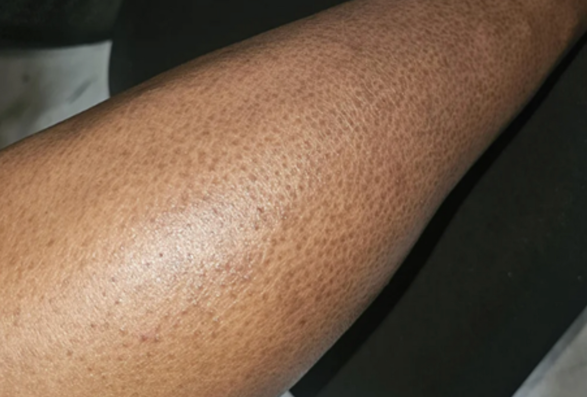 Case 5: Rough, Dull, 'Fish-Scale' Skin — Understanding Xerosis (Severe Dry Skin)