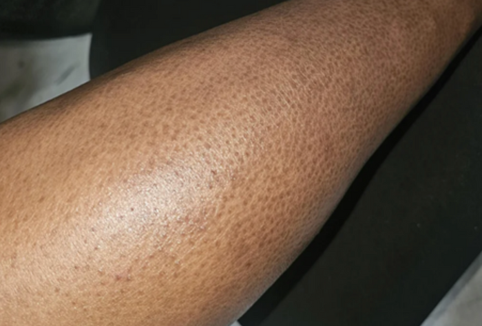 Case 5: Rough, Dull, 'Fish-Scale' Skin — Understanding Xerosis (Severe Dry Skin)