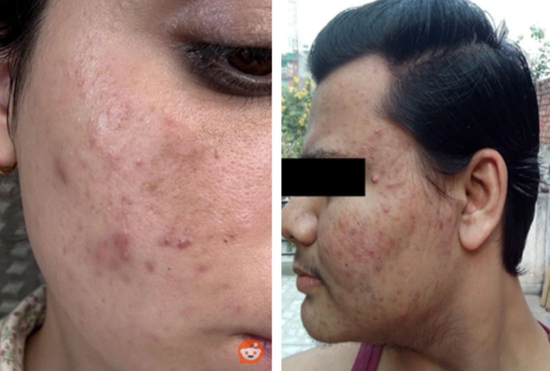 Case 6: Painful Red Bumps and Pus-Filled Pimples — Managing Inflammatory Acne the Right Way