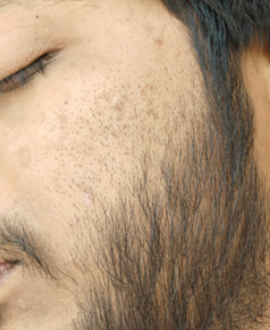 Case 12: Dark Spots Left Behind After Acne — Post-Inflammatory Hyperpigmentation (PIH) in Indian Skin