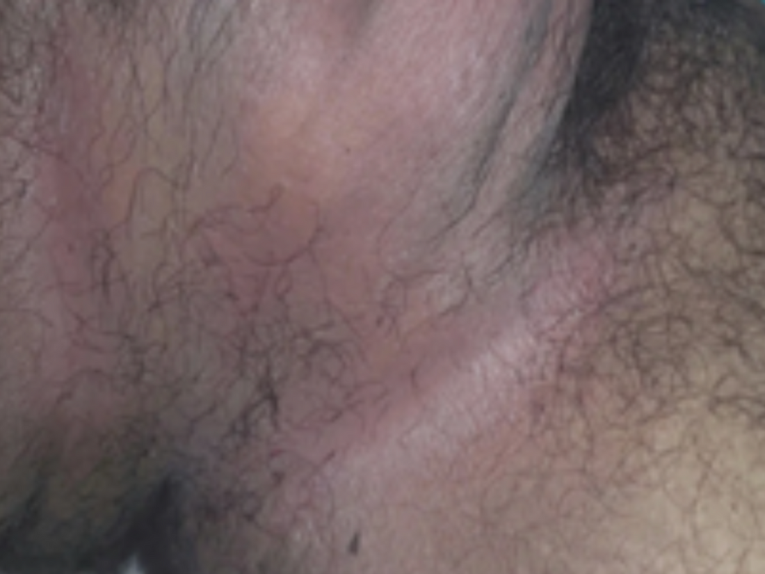 Case 35: Severe Itching and Redness in the Groin Folds — Candidal Intertrigo, the Yeast of Warm, Moist Skin