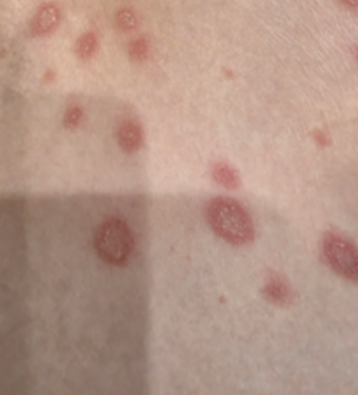 Case 38: Oval Scaly Patches Appearing on Both Daughters — Pityriasis Rosea, the Self-Limiting Rash That Follows a Cold
