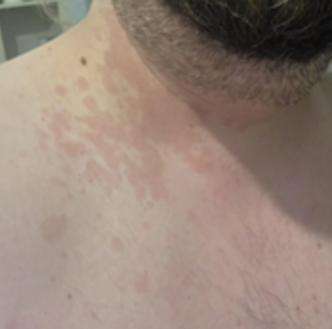 Case 39: Recurrent Reddish Patches on the Neck and Chest Every Summer — Pityriasis Versicolor (Erythematous Variant)