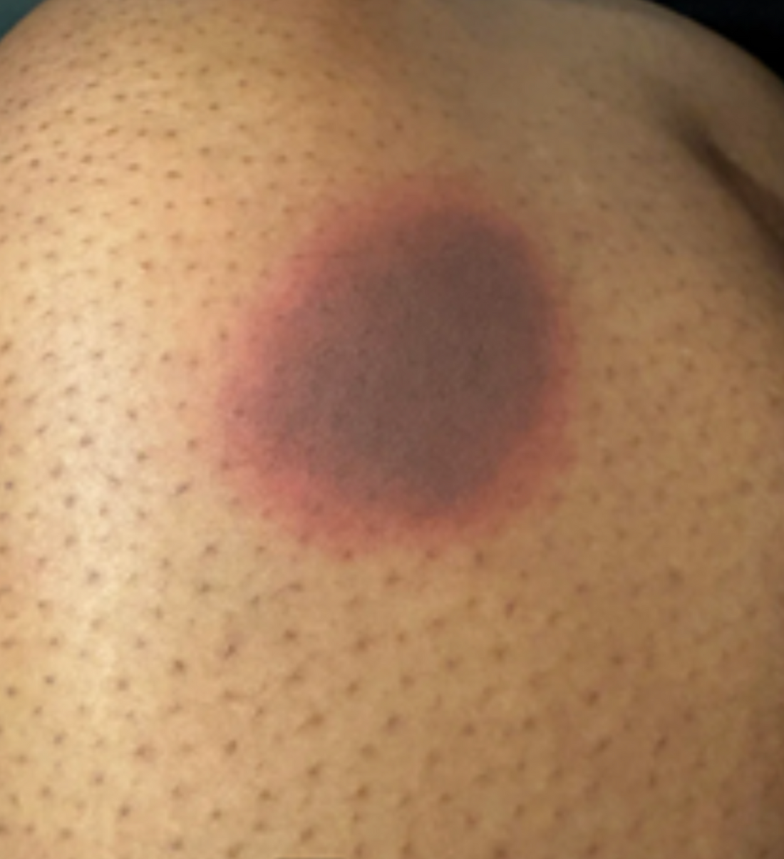 Case 40: A Round Dark Patch That Reappears in the Same Spot After Taking Medicine — Fixed Drug Eruption