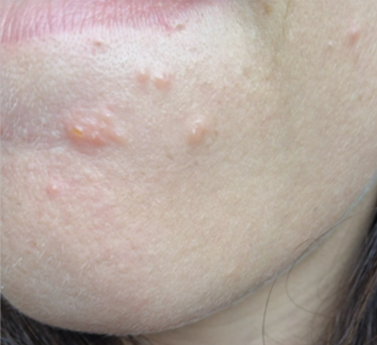 Case 43: Itchy Clustered Blisters Near the Lip That Appeared Overnight — Herpes Labialis (Cold Sores)