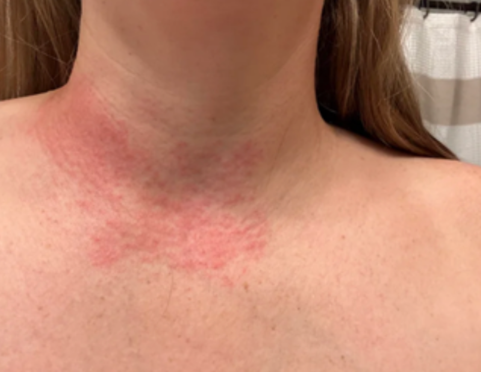 Case 44: A Red Rash Spreading Across the Neck and Chest Since Yesterday — Thinking Through Allergic Contact Dermatitis