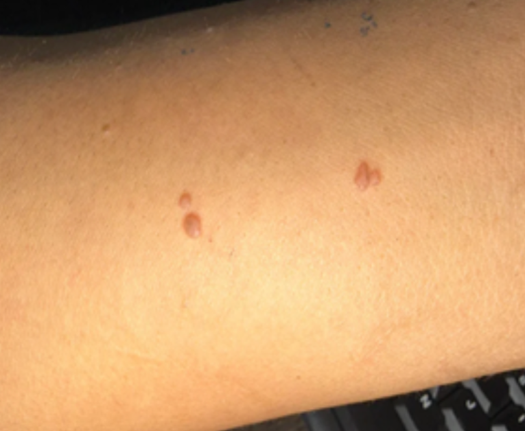 Case 45: Small Smooth Flat Bumps Multiplying on the Forearm — Flat Warts (Verruca Plana)