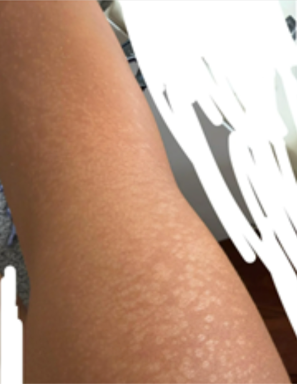 Case 46: White Spots Slowly Growing on the Trunk — Progressive Macular Hypomelanosis vs Pityriasis Versicolor