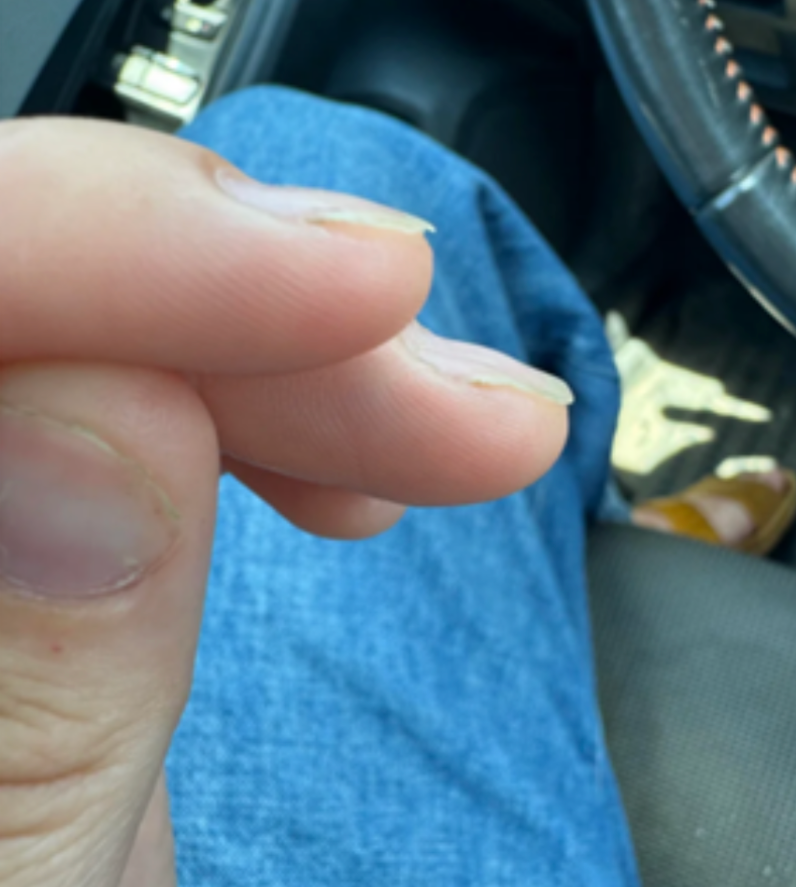 Case 47: Spoon-Shaped Nails the Dermatologist Couldn't Explain — Koilonychia and What It Can Reveal