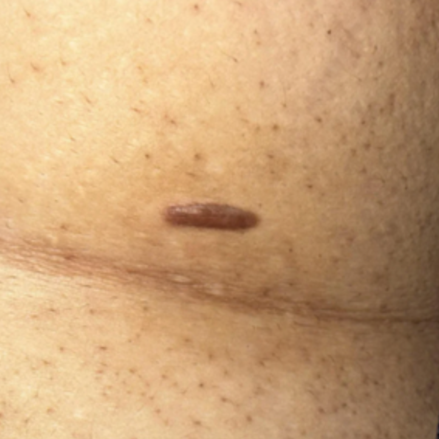 Case 48: A Firm Raised Scar That Won't Flatten — Hypertrophic Scars, and How They Differ From Keloids