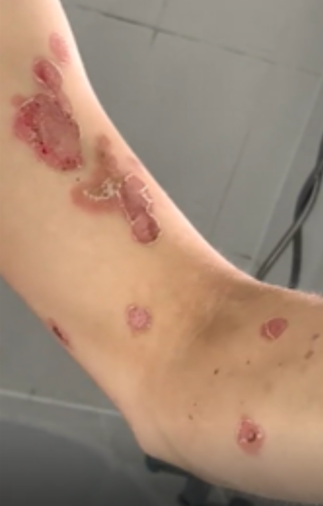 Case 49: Fragile Blisters That Burst Into Raw Pink Patches — Bullous Impetigo, the Contagious Rash to Treat Early