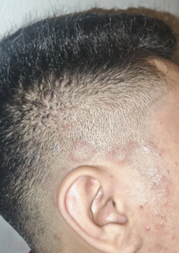 Case 50: A Scaly Patch Appearing on the Scalp Right After a Haircut — Sebopsoriasis, Not a Barbershop Infection