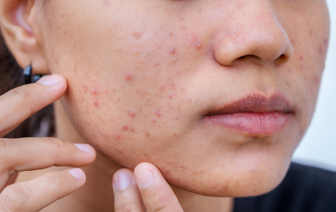 Why Your Acne Keeps Coming Back (And What You Can Do About It)