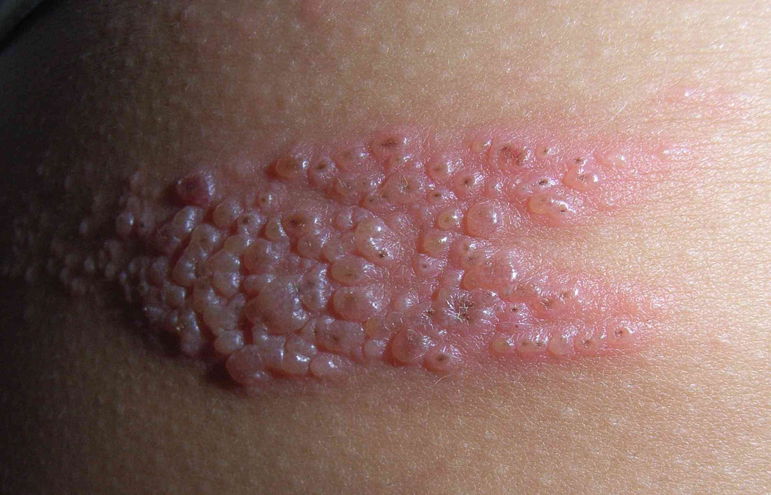 Case 41: Painful Recurring Boils and Scars in the Groin for Years — Hidradenitis Suppurativa (HS)