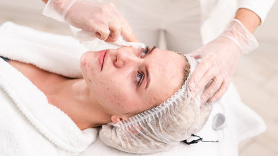 Acne Scar Treatment Explained: Types of Scars, Best Treatments, Timelines, and What Actually Works