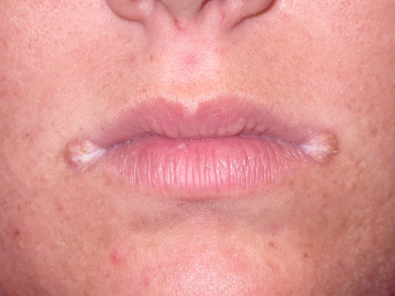 Case 26: Painful Fissure at the Corner of the Mouth — A Clinical Look at Angular Cheilitis