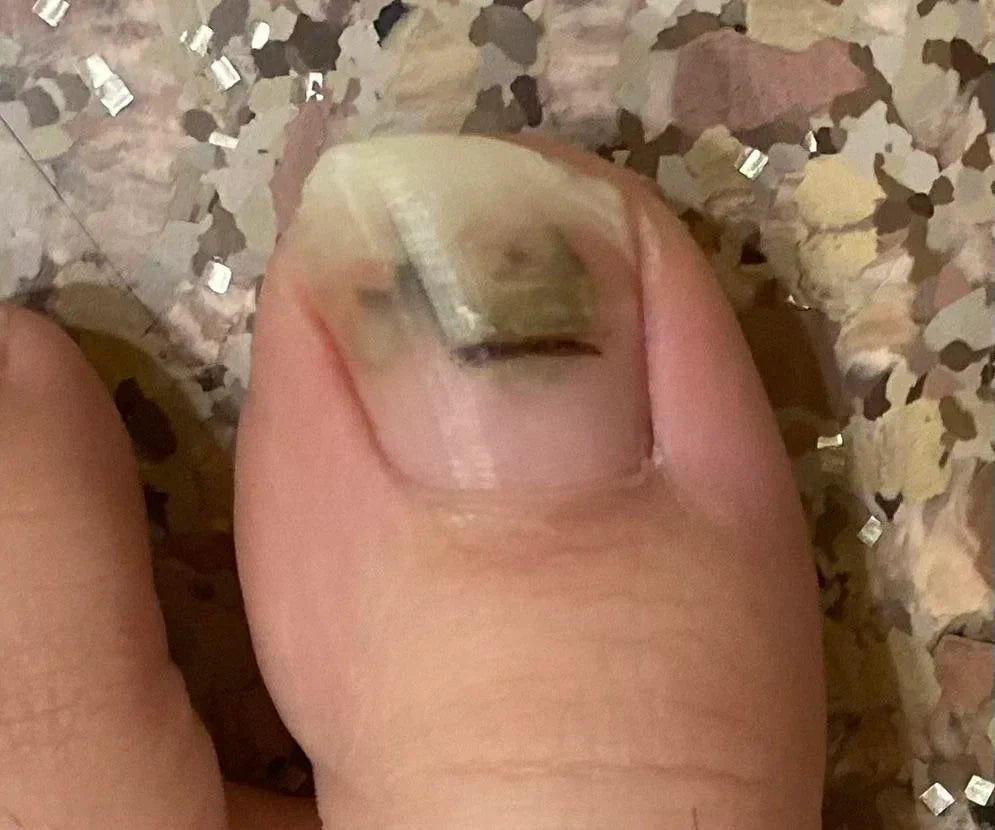 Case 32: A Dark Band Under the Toenail After Injury — Subungual Hematoma or Nail Melanoma?